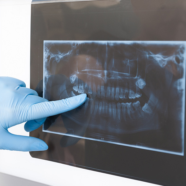 RX PERIAPICAL RX PERIAPICAL