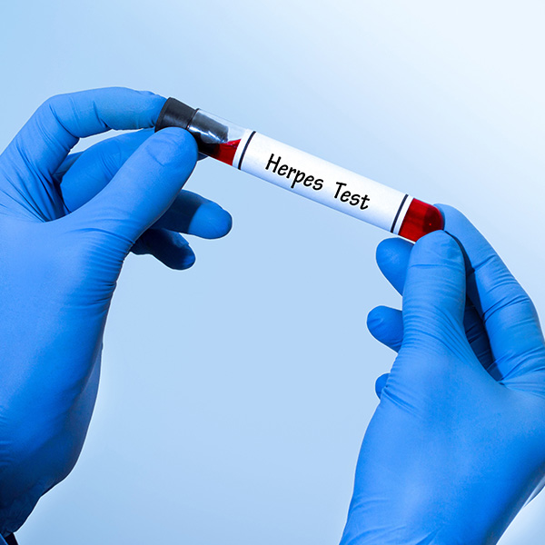 AC. ANTI HERPES I IGM