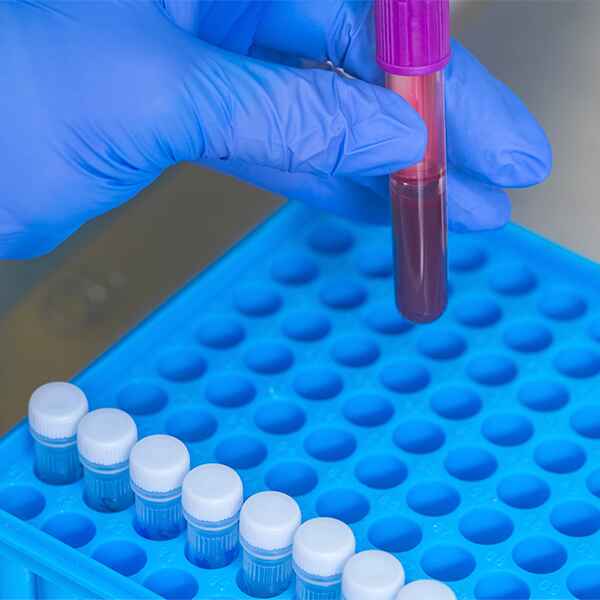 BCL-2 MARCADOR DE INMUNOHISTOQUÍMICA