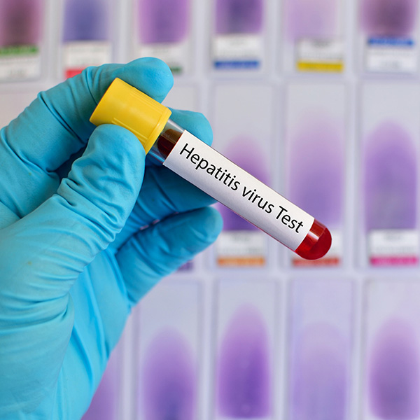AC. ANTI HEPATITIS E IGM, IGM AC. ANTI HEPATITIS E IGM, IGM