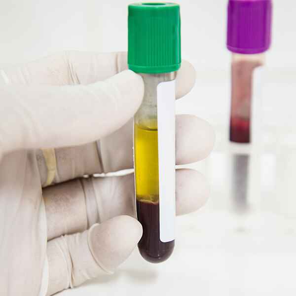 ANTICUERPOS IGM HEPATITIS E ANTICUERPOS IGM HEPATITIS E