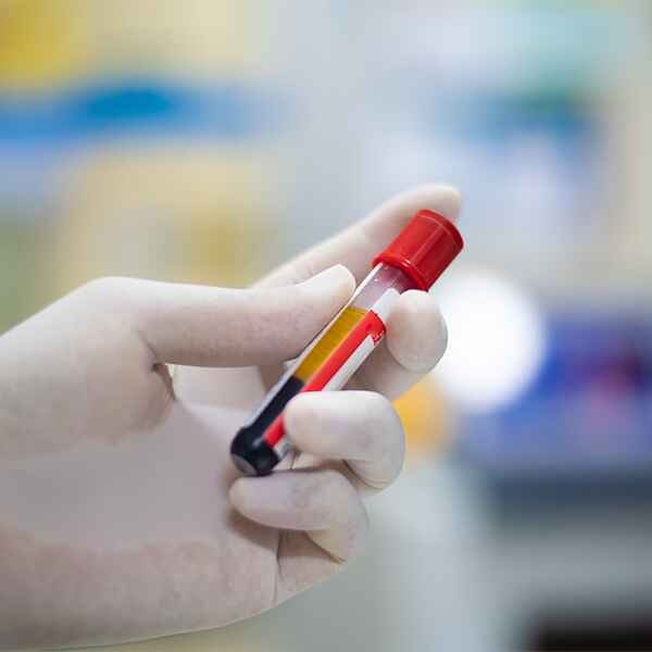 ANTICUERPOS LGI1 ANTICUERPOS LGI1