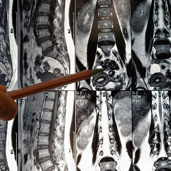 RM COLUMNA LUMBAR SIMPLE