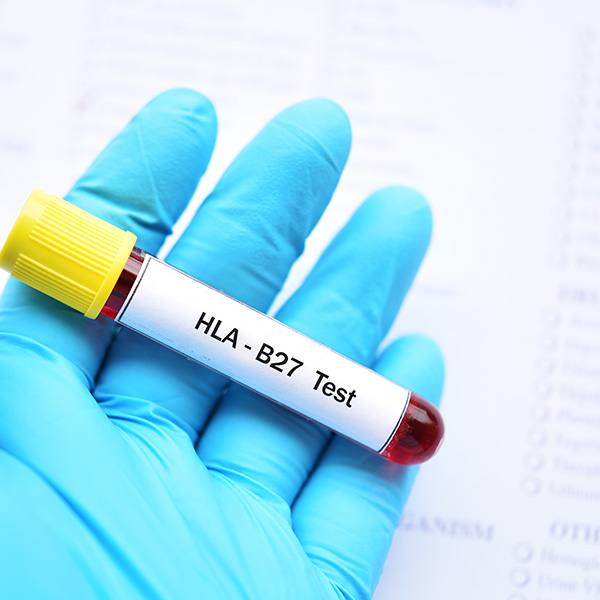ANTÍGENO HLA-B27 ESPONDILITIS ANQUILOSANTE