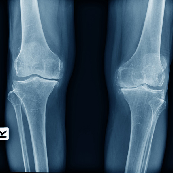 RX PIERNA TIBIA Y PERONE AP Y LATERAL RX PIERNA TIBIA Y PERONE AP Y LATERAL