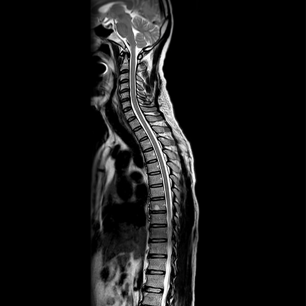 RX COLUMNA DORSAL AP Y LATERAL RX COLUMNA DORSAL AP Y LATERAL
