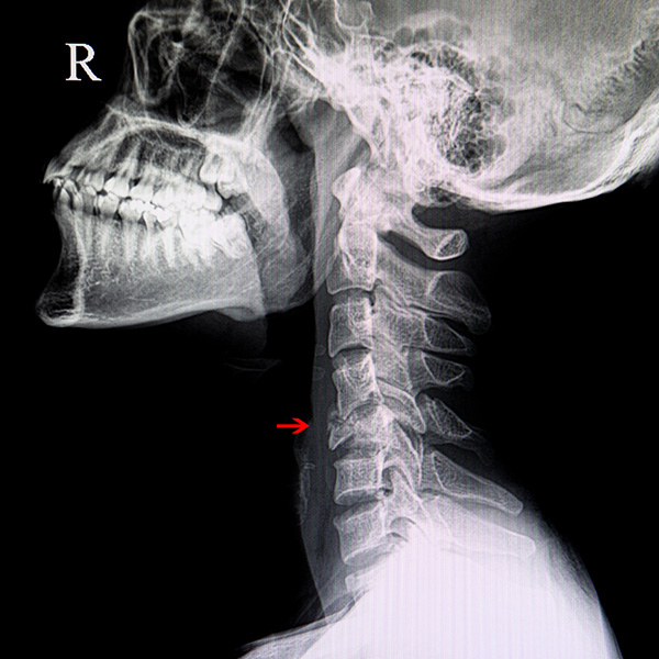 RX CUELLO LATERAL PARA TEJIDOS BLANDOS RX CUELLO LATERAL PARA TEJIDOS BLANDOS