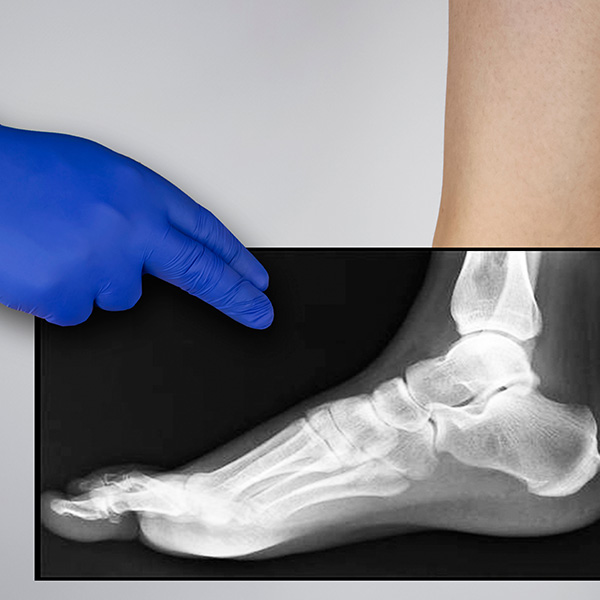 RX PIE AP DORSO PLANTAR