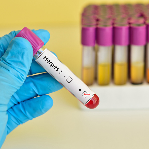 AC. ANTI HERPES II IGM