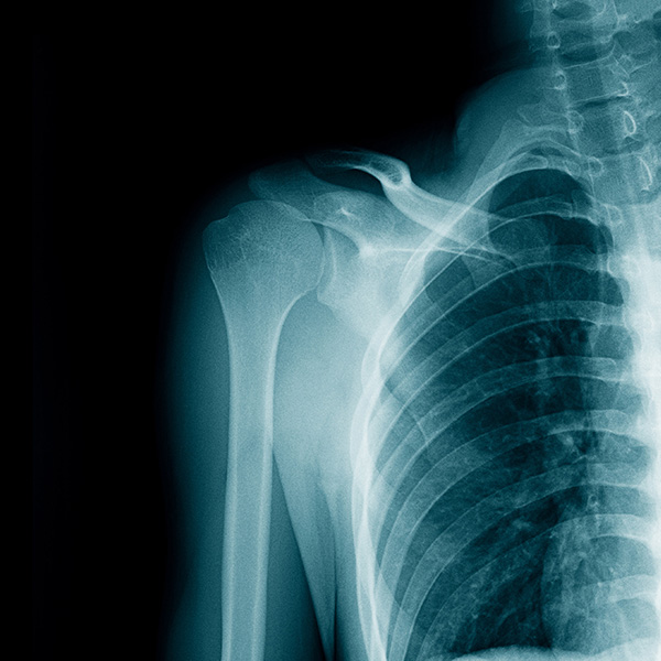 RX CLAVICULA AP RX CLAVICULA AP