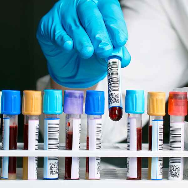 AC. PAROTIDITIS IgM EN SANGRE