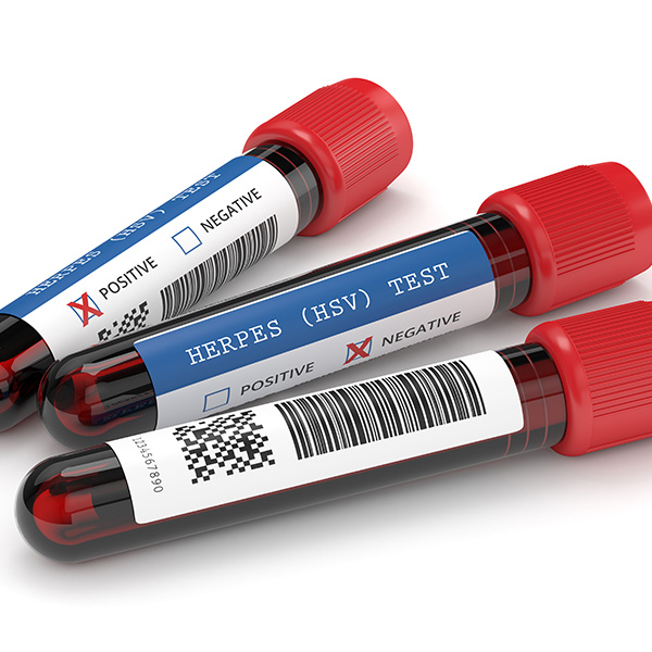 AC. ANTI HERPES II IGM AC. ANTI HERPES II IGM